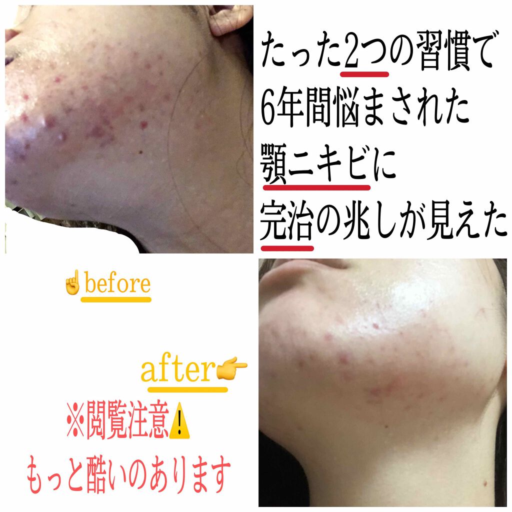 パピコ28世 on LIPS 「ニキビが治ってきて、この喜びを忘れないために、辛かったことを忘..」(1枚目)