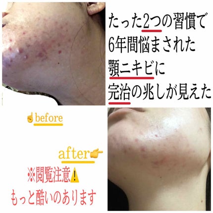 ベピオゲル/マルホ株式会社/その他を使ったクチコミ(1枚目)