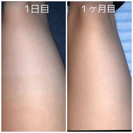 光脱毛器 VIO/Sarlisi/家庭用脱毛器を使ったクチコミ(3枚目)