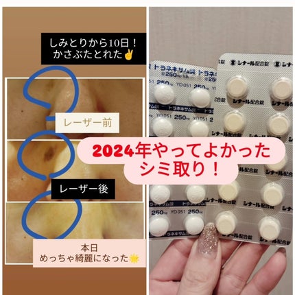 トラネキサム酸 250mg/東和薬品/その他を使ったクチコミ(1枚目)