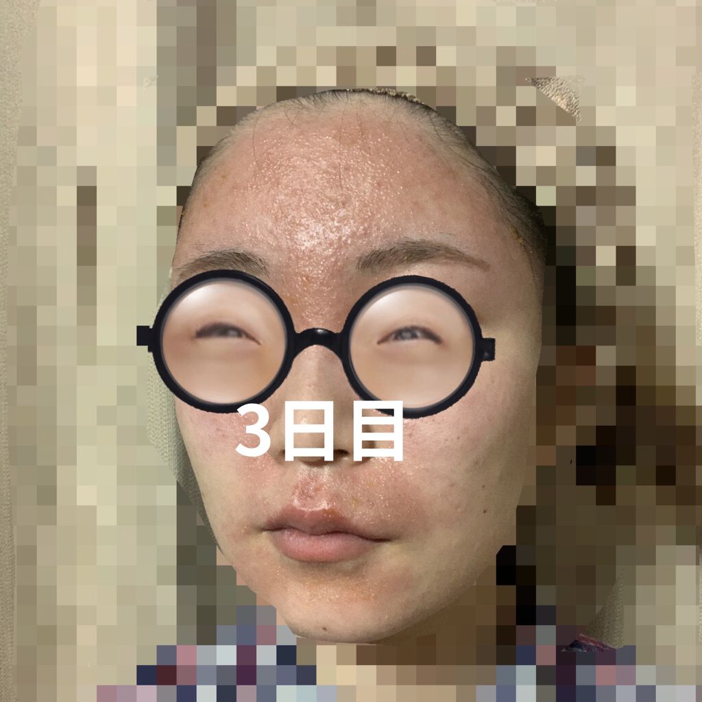 デュアック配合ゲル/ポーラファルマ/その他を使ったクチコミ（2枚目）