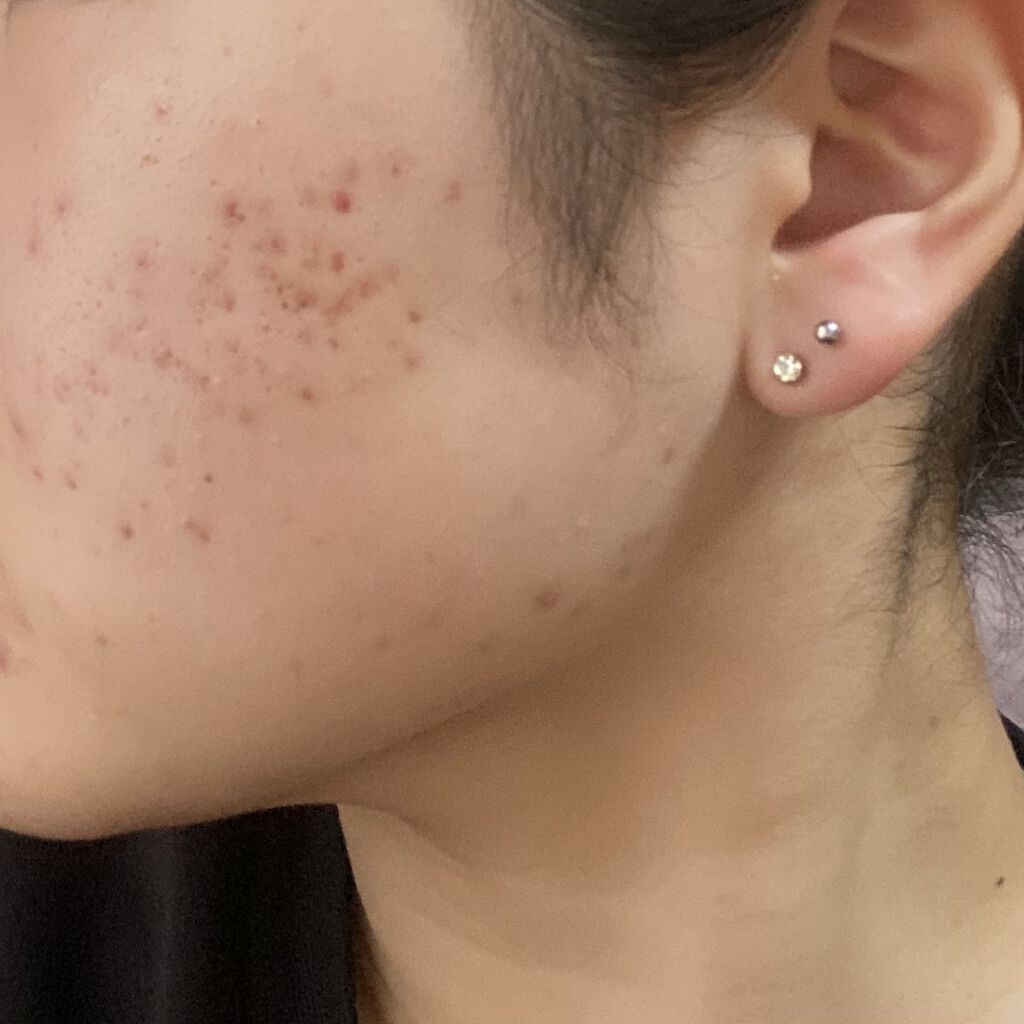 オードムーゲ 薬用ローション（ふきとり化粧水）/オードムーゲ/拭き取り化粧水を使ったクチコミ（1枚目）