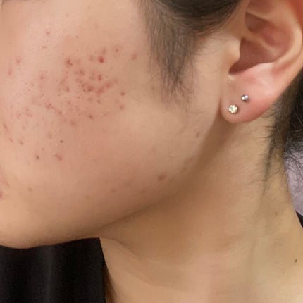 オードムーゲ 薬用ローション(ふきとり化粧水)/オードムーゲ/拭き取り化粧水を使ったクチコミ(1枚目)