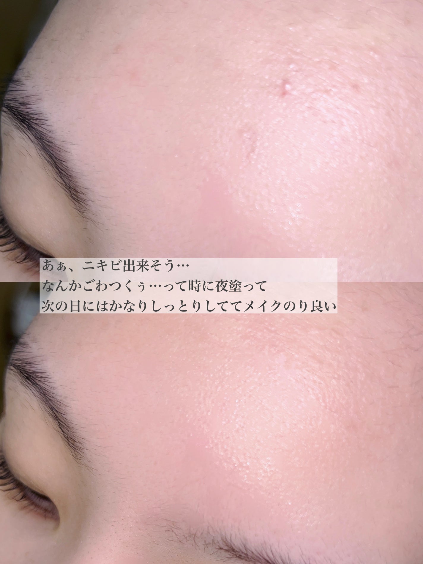 ピンクティーツリーシナジーセラム/APLIN/美容液を使ったクチコミ(4枚目)