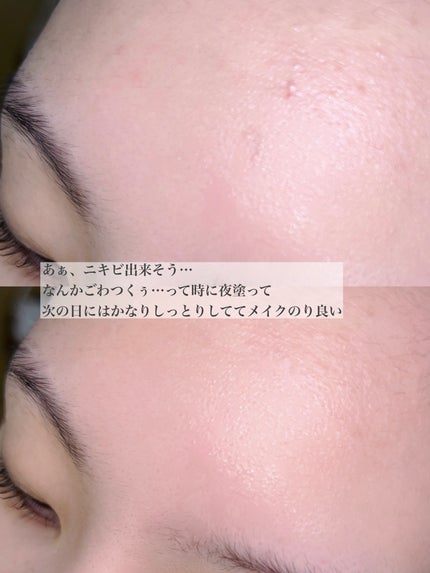 ピンクティーツリーシナジーセラム/APLIN/美容液を使ったクチコミ(4枚目)