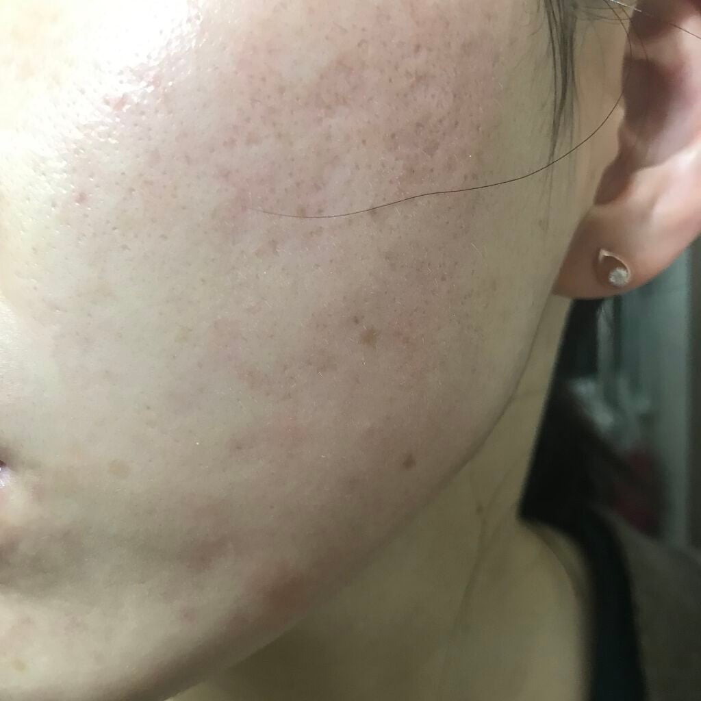 AHA 30% + BHA 2% Peeling Solution/The Ordinary/ピーリングを使ったクチコミ(2枚目)