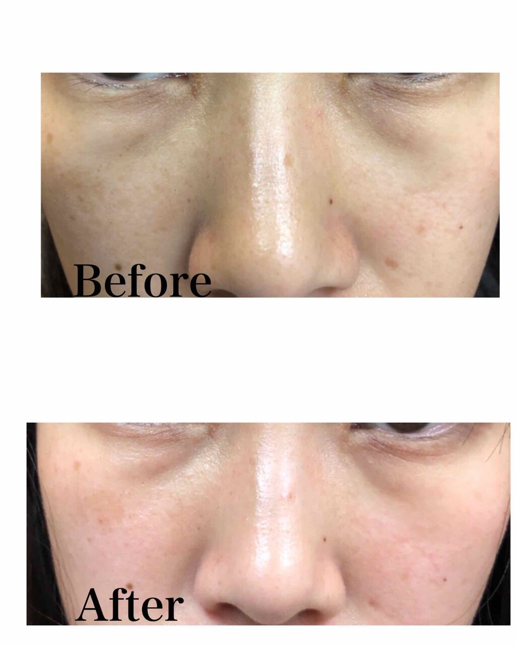 せいあや on LIPS 「こんにちはトランシーノⅡ60錠飲み終わりました!!シミはまだ消..」(2枚目)