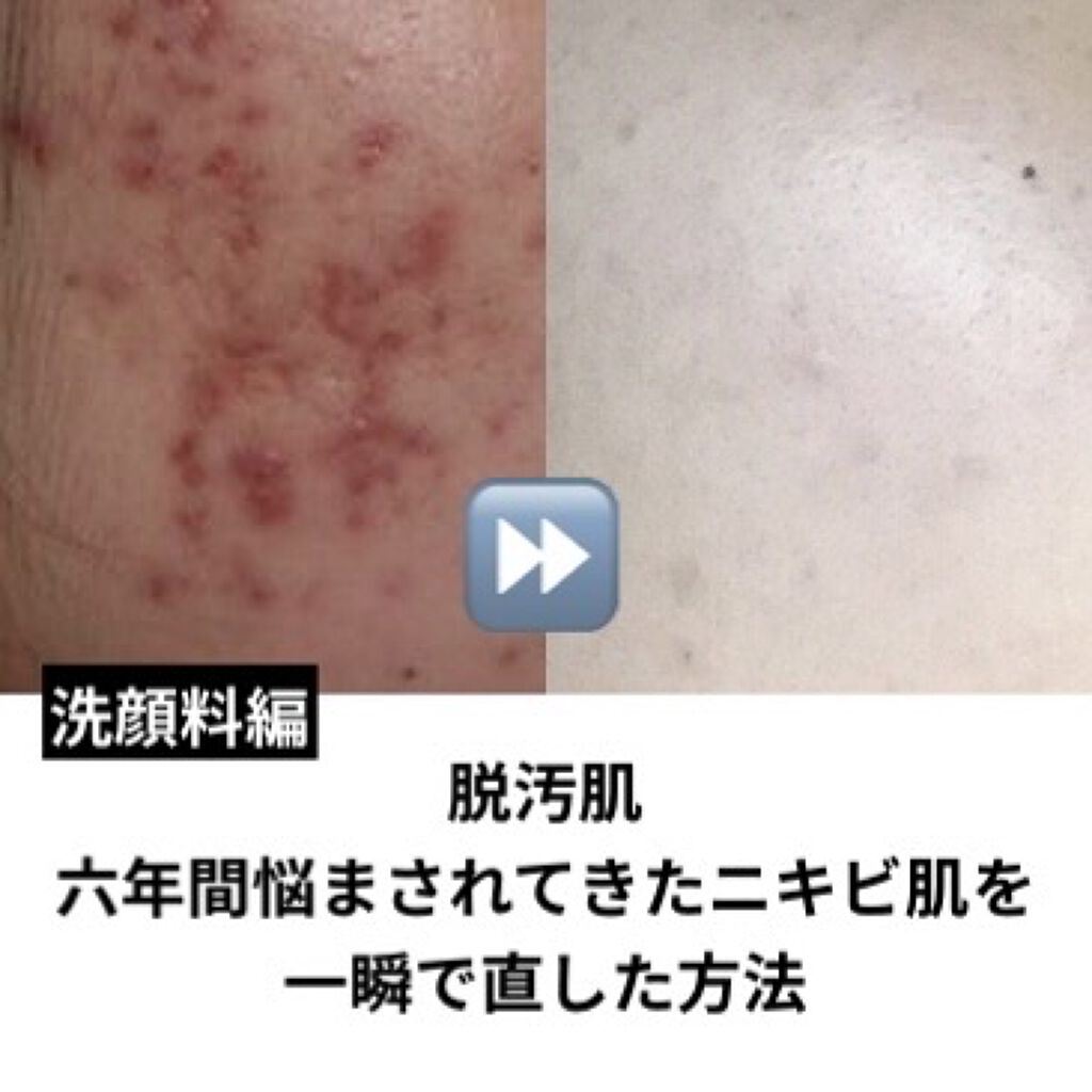 ロゼット洗顔パスタ アクネクリア/ロゼット/洗顔フォームを使ったクチコミ（1枚目）