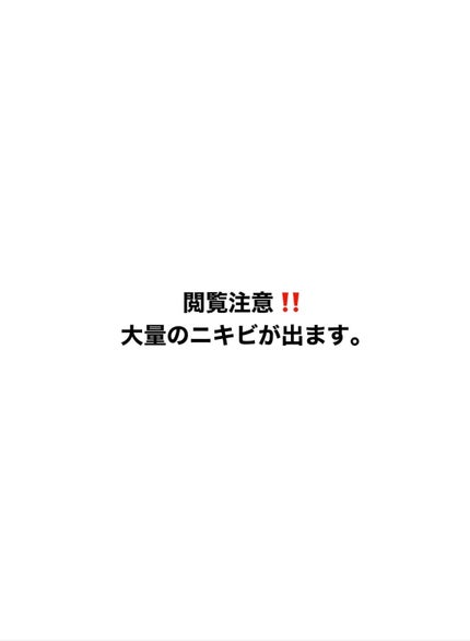 思春期ニキビ撲滅隊☆ on LIPS 「閲覧注意です‼️⭐️ニキビ日記見た目は全然変わってないけど、自..」(1枚目)