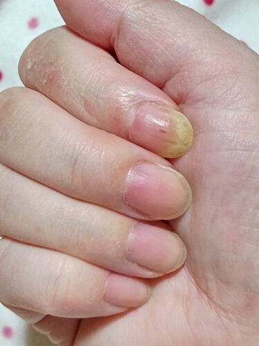 薬用ハンドクリーム Dhcを使った口コミ 追記 怪我による右手人差し指の爪甲剥離症 By らいな リムるならフォローしないで 怒 敏感肌 Lips