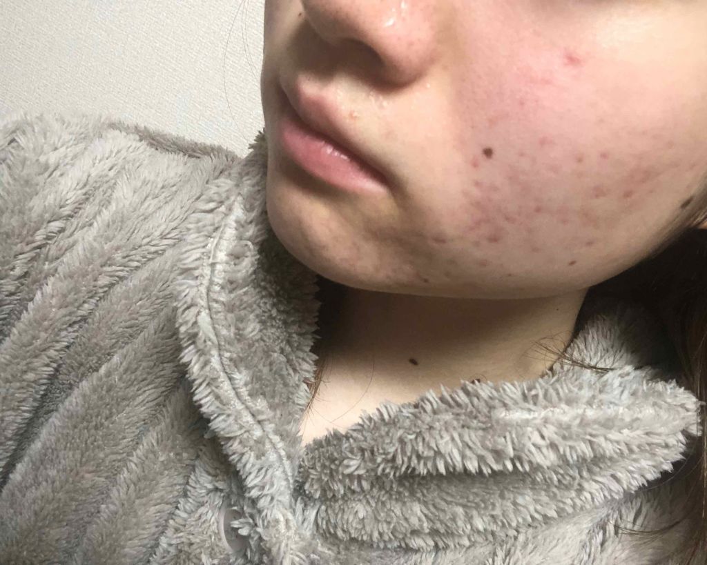 バイオイル/バイオイル/フェイスオイルを使ったクチコミ(4枚目)