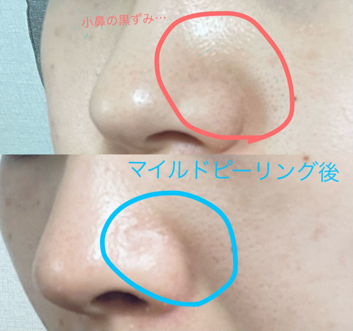 フェイシャルマイルドピーリング/primera/ピーリングを使ったクチコミ（1枚目）
