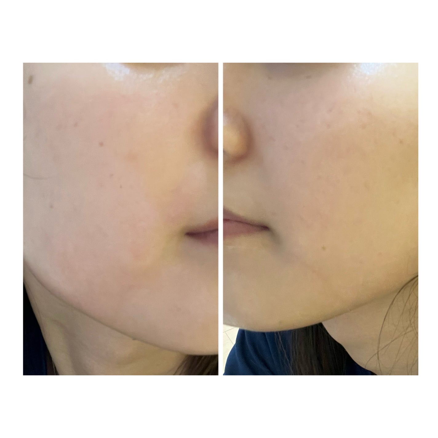 ぽむ on LIPS 「2023.9.13皮膚科に受診 エピデュオとヘパリン処方1枚目..」(1枚目)