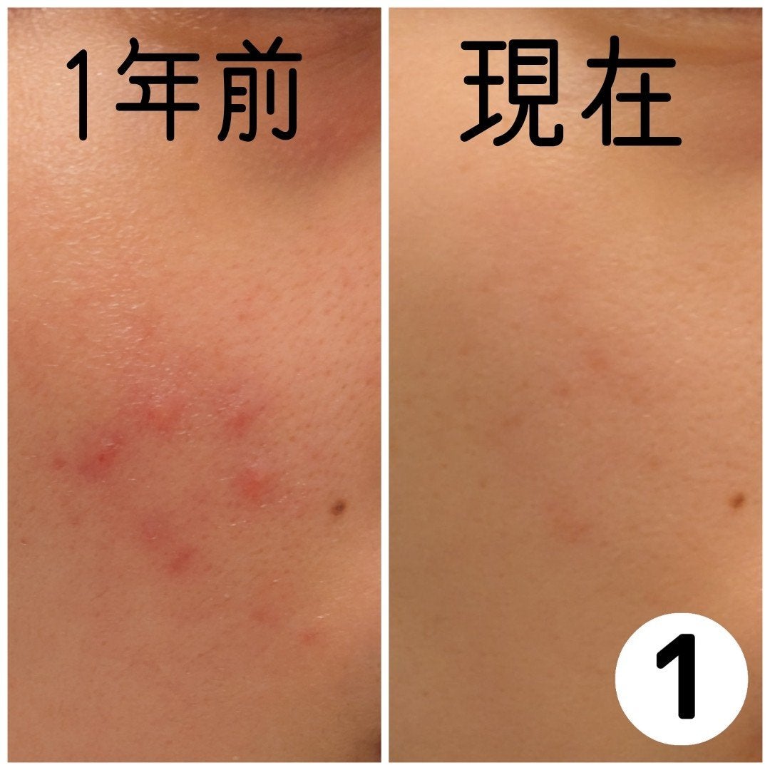 もか【スキンケア】 on LIPS 「【肌荒れが無理すぎて鏡見るのも出かけるのも全瞬間自己嫌悪に陥る..」(3枚目)