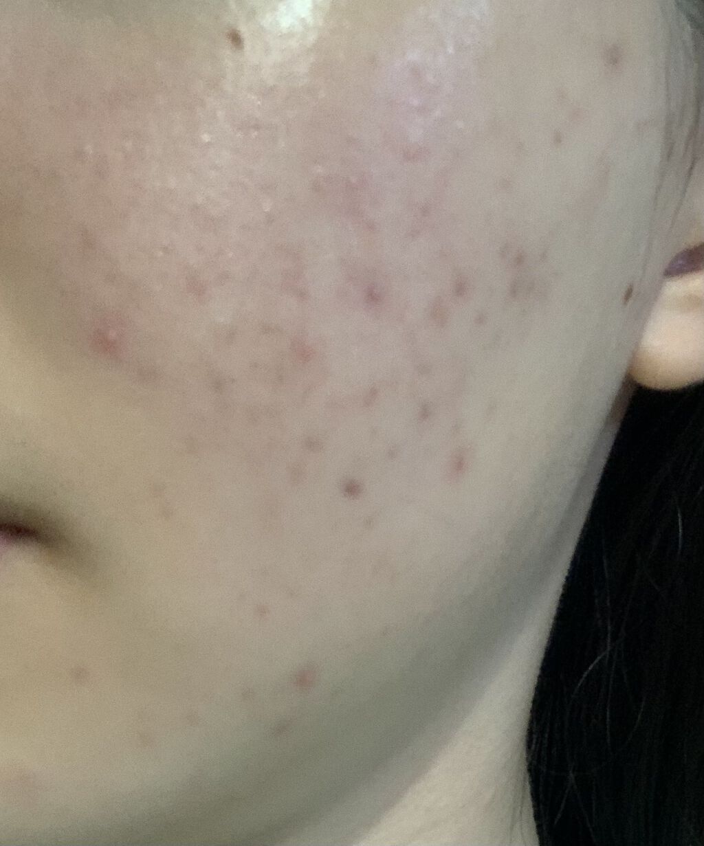 Ａ アクネジェル/NOV/美容液を使ったクチコミ（2枚目）