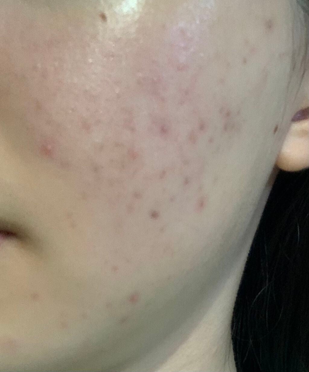 A アクネジェル/NOV/美容液を使ったクチコミ(2枚目)