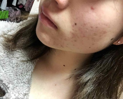 マンスリースキンケアプログラム(旧)/APEX/スキンケアキットを使ったクチコミ(4枚目)