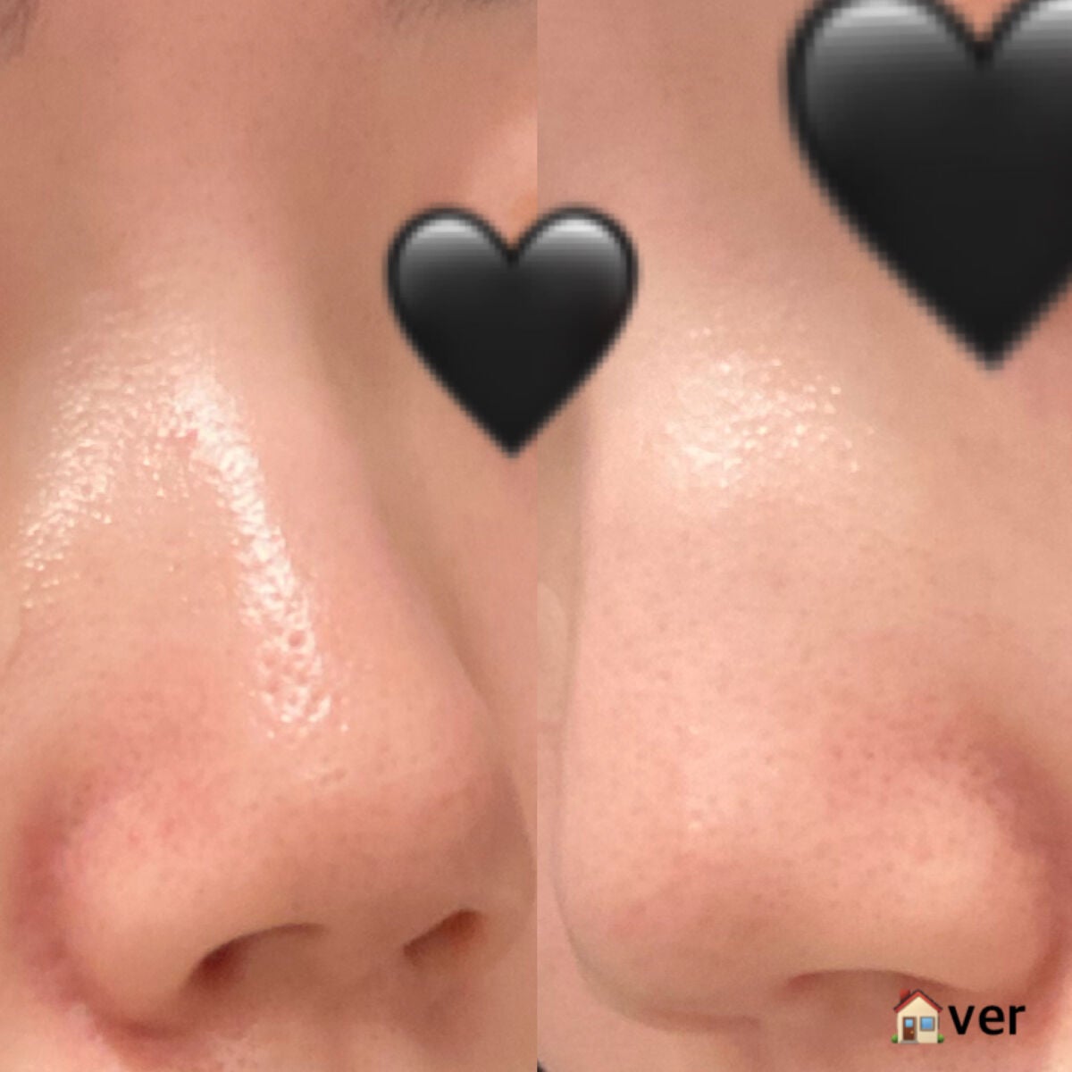 憫(びん) on LIPS 「【たった1000円! 毛穴が気になる方必見‼︎😳】 ⚠️bef..」(6枚目)