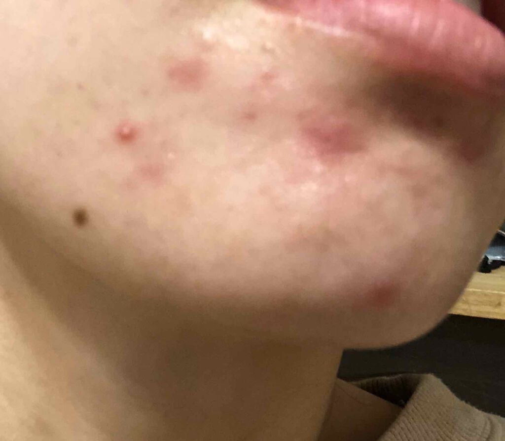 mama28 on LIPS 「#ガチレビュー#しこりニキビ#顎ニキビ#大人ニキビ#ベピオゲル..」(1枚目)