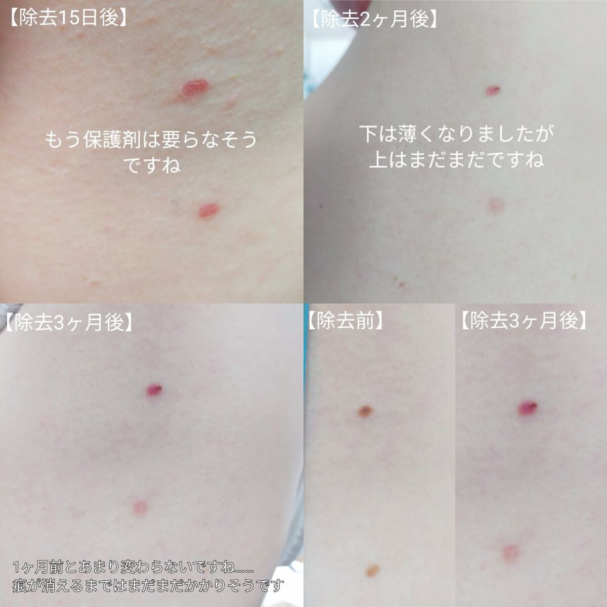 敏感肌な研究者💊あすか💊 on LIPS 「#ホクロをレーザーで除去したお話の経過報告です⚠️患部の写真が..」(5枚目)