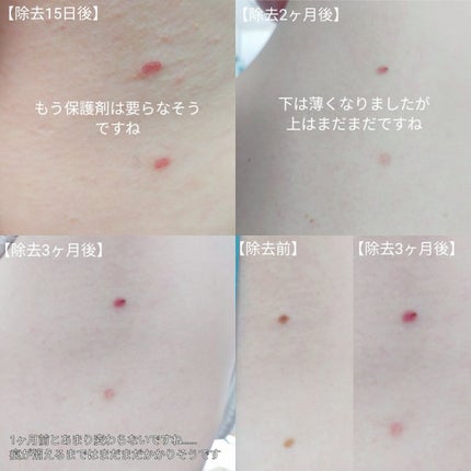 敏感肌な研究者💊あすか💊 on LIPS 「#ホクロをレーザーで除去したお話の経過報告です⚠️患部の写真が..」(5枚目)