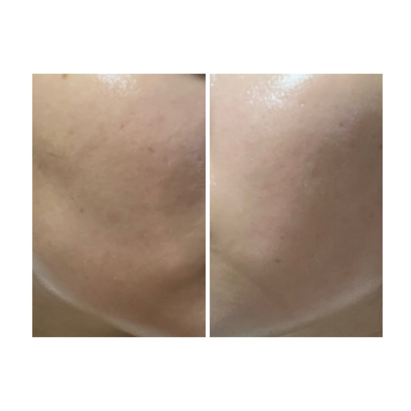 ぽむ on LIPS 「2023.9.13皮膚科に受診 エピデュオとヘパリン処方1枚目..」(5枚目)