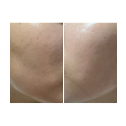 ぽむ on LIPS 「2023.9.13皮膚科に受診 エピデュオとヘパリン処方1枚目..」(5枚目)