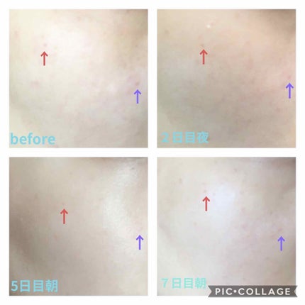 EUKROMA ハイドロキノンクリーム4% 20g/EUKROMA/その他スキンケアを使ったクチコミ(2枚目)