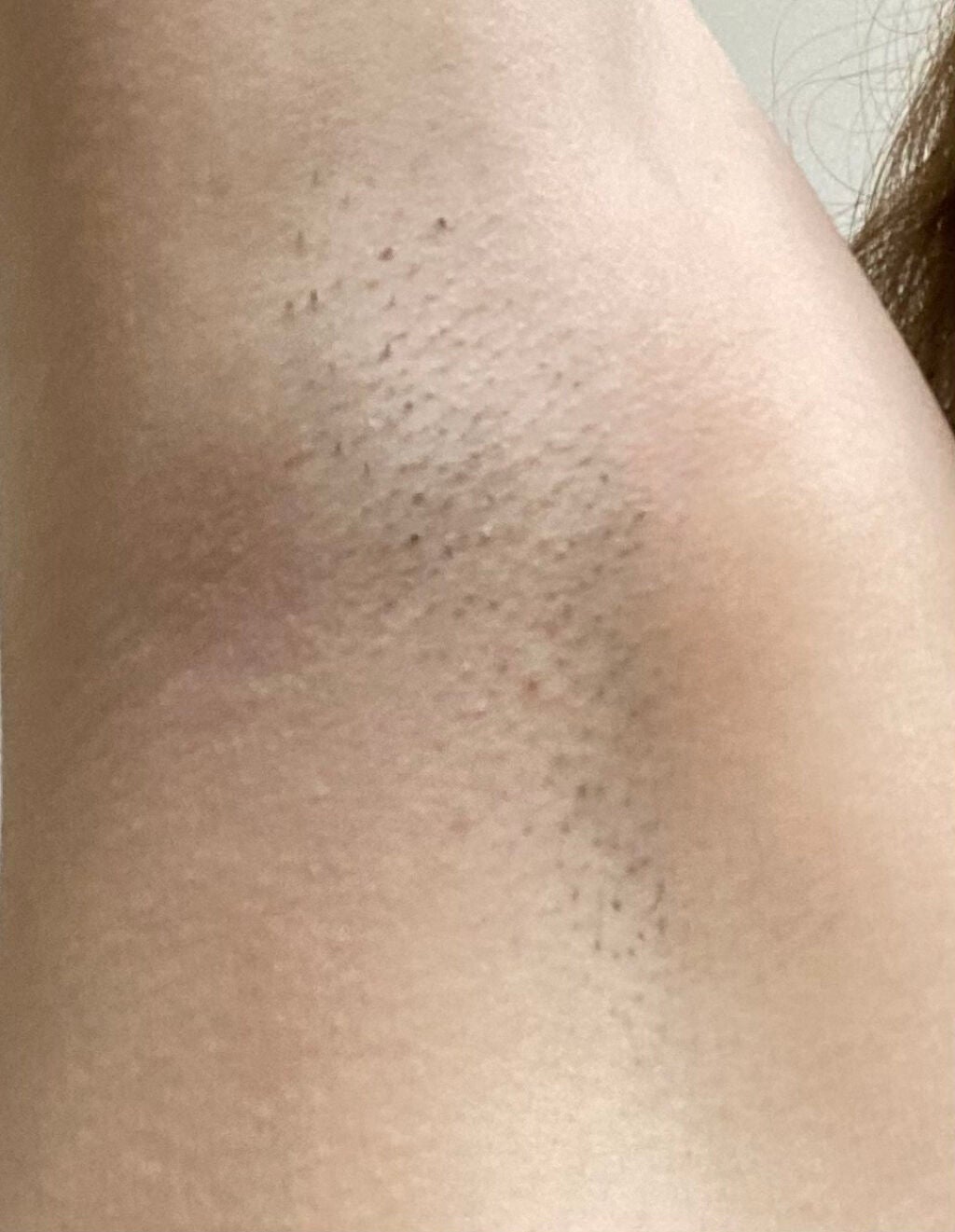 アイスレディ/icelady/家庭用脱毛器を使ったクチコミ(6枚目)