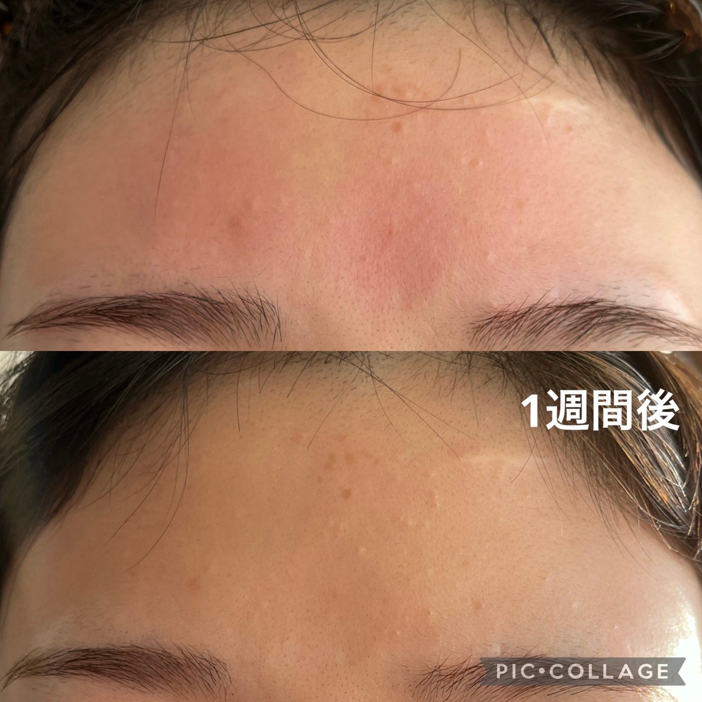 アクネケア セット MB/d プログラム/トライアルキットを使ったクチコミ(2枚目)