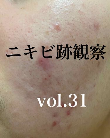 クレーター 話題沸騰中のコスメ 真似したいメイク方法の口コミが98件 デパコスからプチプラまで 2ページ目 Lips