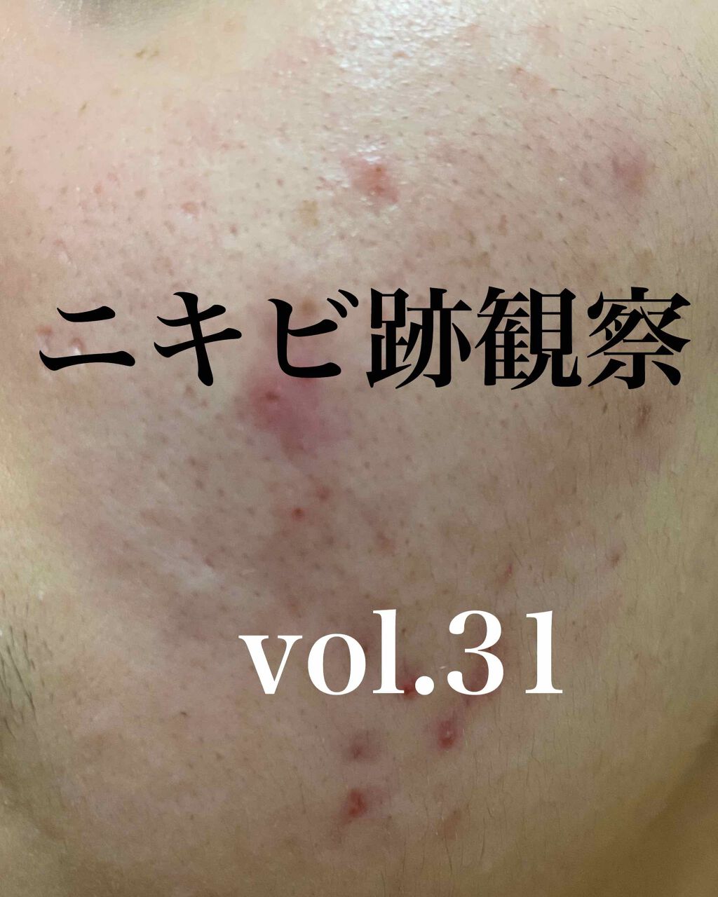 Etude 無印良品 メラノccのスキンケア 基礎化粧品を使った口コミ 昨日潰れた大きなニキビクレーター確定だ By さい 敏感肌 代前半 Lips Etude 無印良品 メラノccのスキンケア 基礎化粧品を使った口コミ 昨日潰れた大きなニキビクレーター確定だ By さい 敏感肌 代前半 Lips