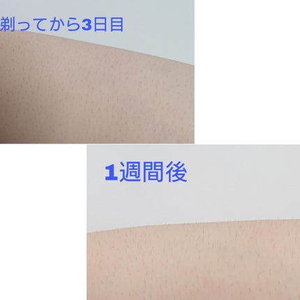 スムーズスキンbare(旧型)/スムーズスキン/家庭用脱毛器を使ったクチコミ(2枚目)