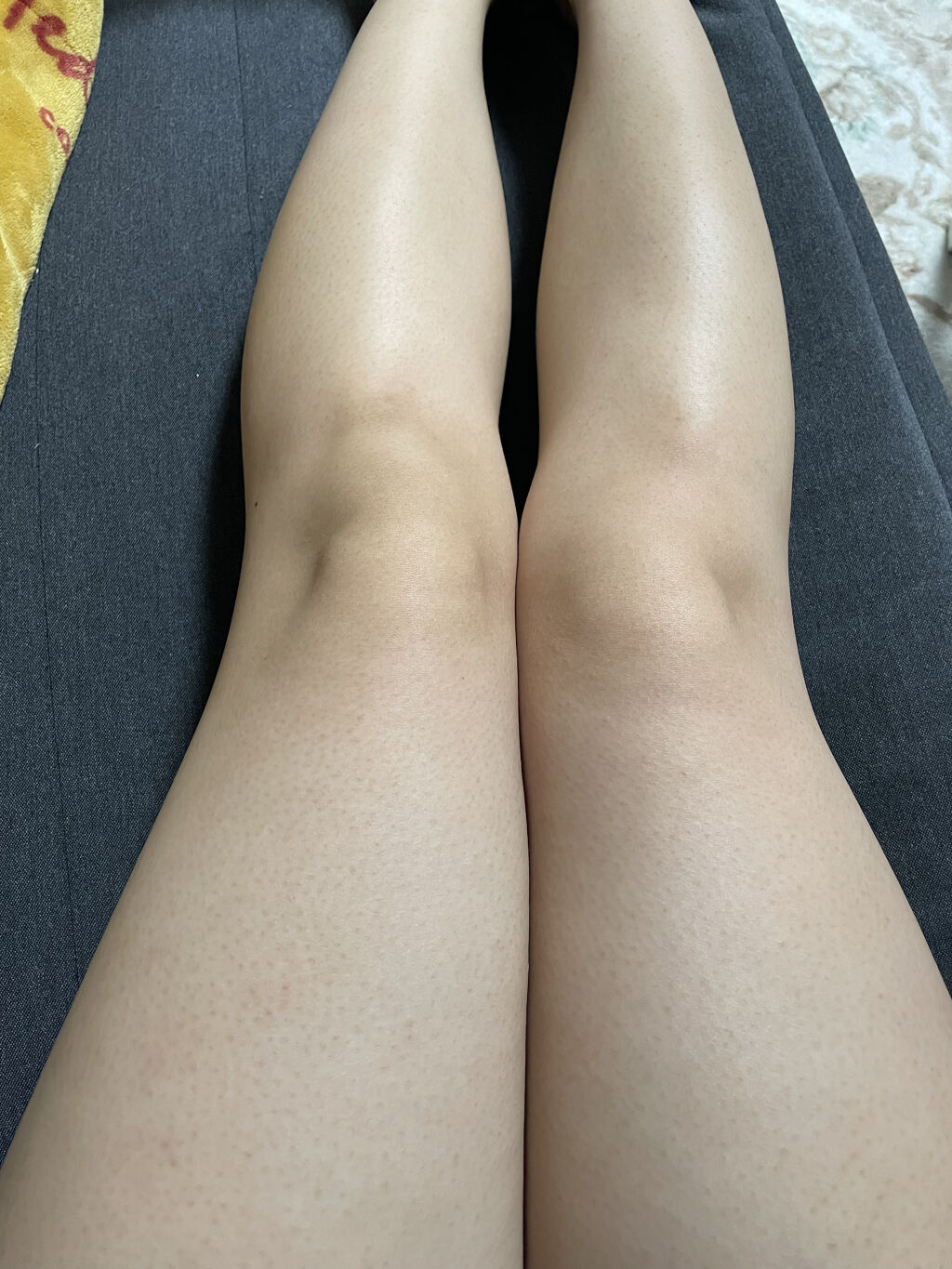 アイスレディ/icelady/家庭用脱毛器を使ったクチコミ（2枚目）