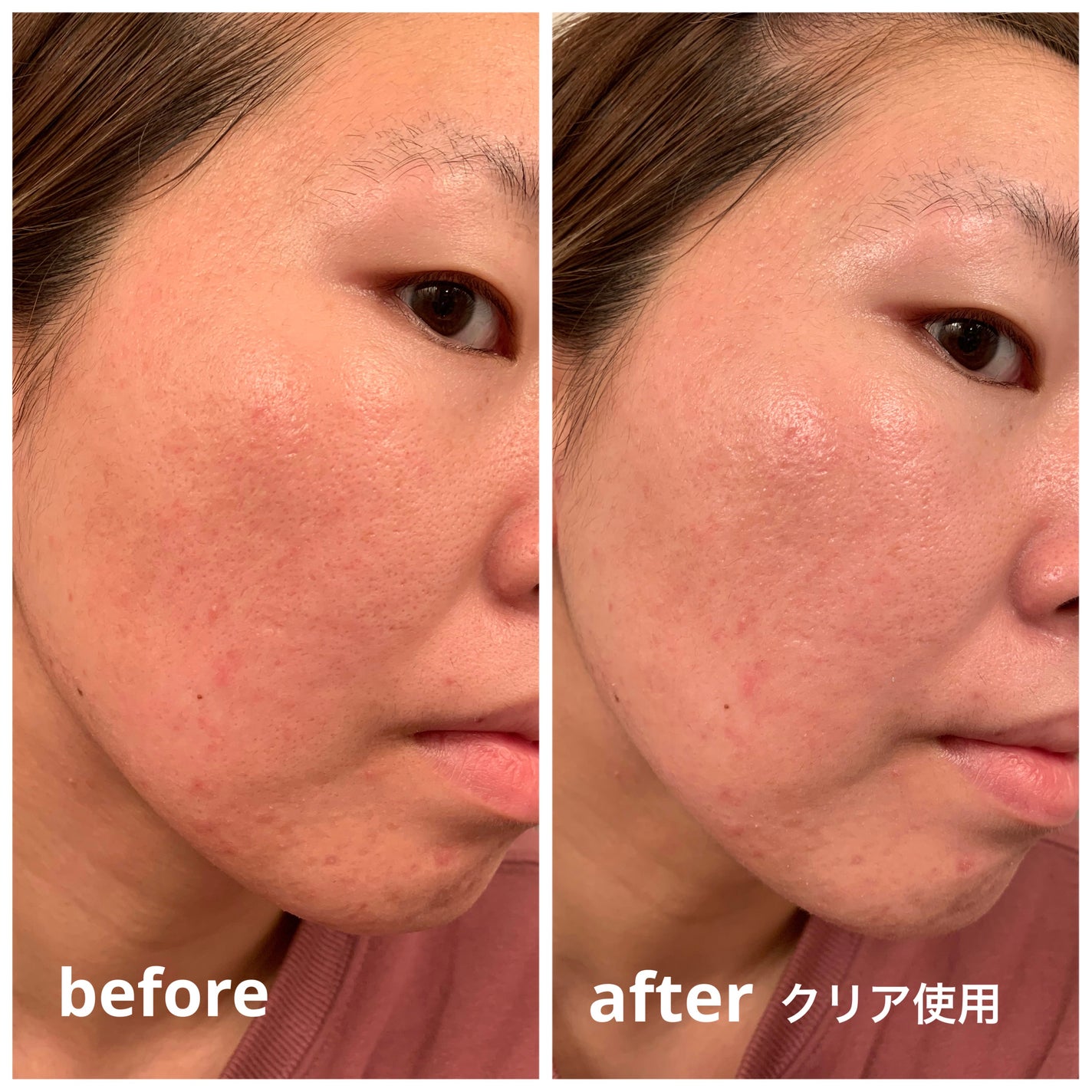 UVã€ã㢠XL ãããã¯ã·ã§ã³ããŒã³ã¢ãã ããŒãº/ã© ããã·ã¥ ããŒ/æ¥çŒãæ¢ãã¯ãªãŒã ã䜿ã£ãã¯ãã³ãïŒ9æç®ïŒ