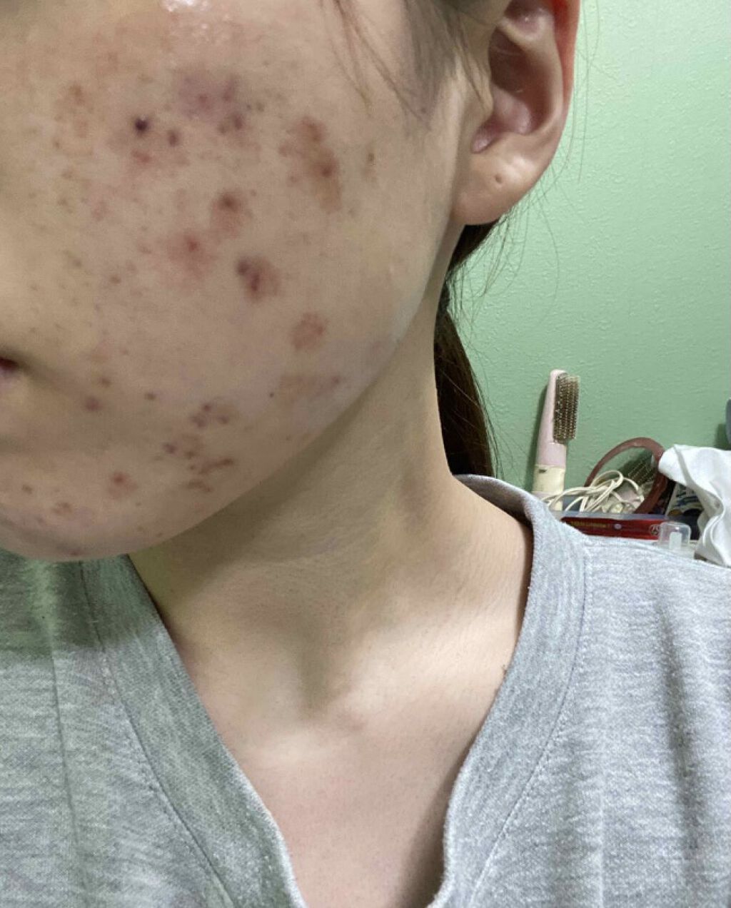 オロナインＨ軟膏 (医薬品)/オロナイン/その他を使ったクチコミ（3枚目）