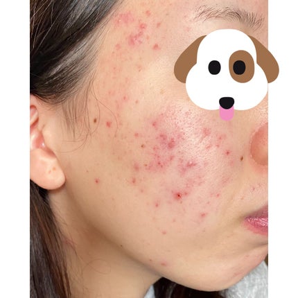 モイスチュア ローション/カルテHD/化粧水を使ったクチコミ(2枚目)