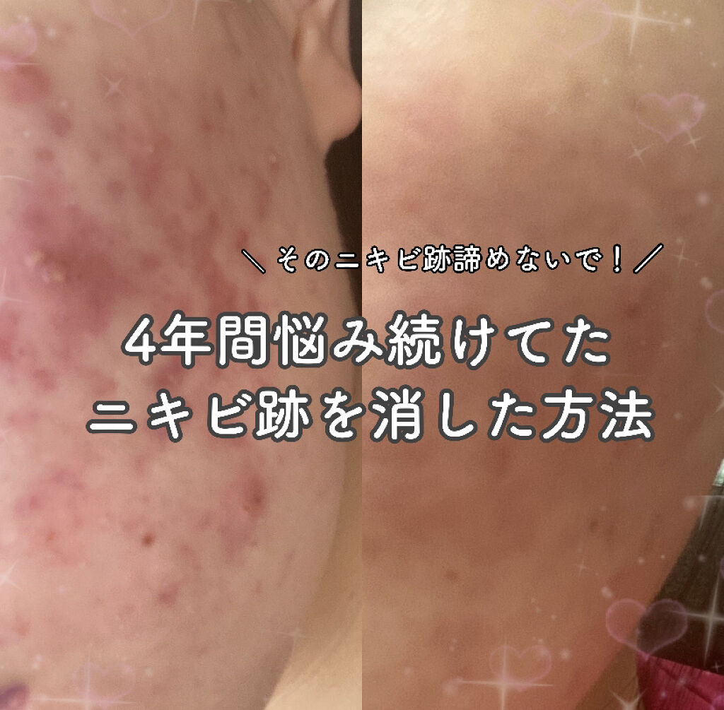 ACアクティブ フェイスローション モイスト/NOV/化粧水を使ったクチコミ（1枚目）