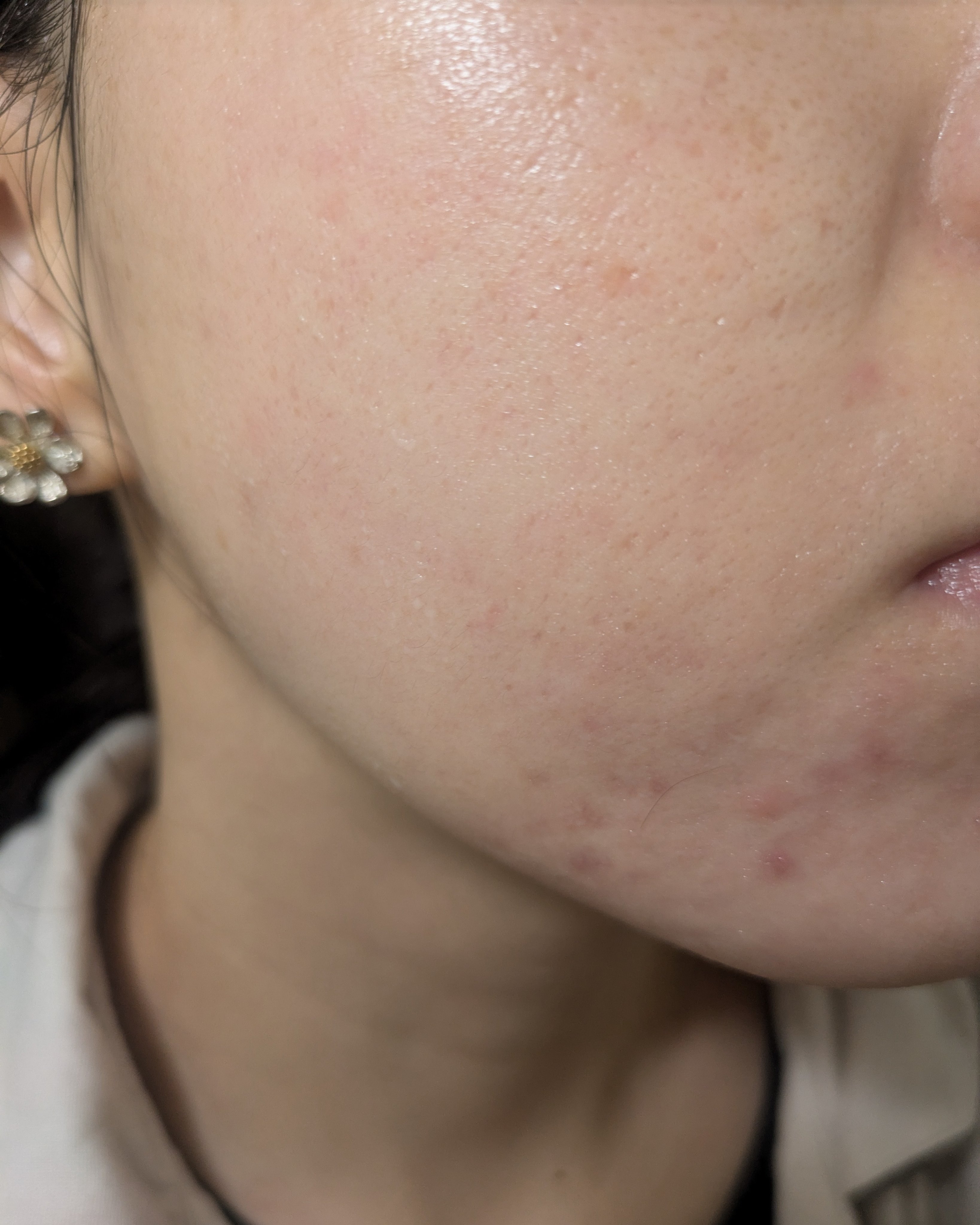 11/2の#汚肌工事録


💐肌がのためにやっていること

💊乳酸菌やビタミンサプリ:朝昼晩(昼はたまに抜かしちゃう)
💊低量ピルも飲んでます！(酷かった生理ニキビや生理痛・PMSは軽減されました)

🥤💧を2L飲むことを意識して