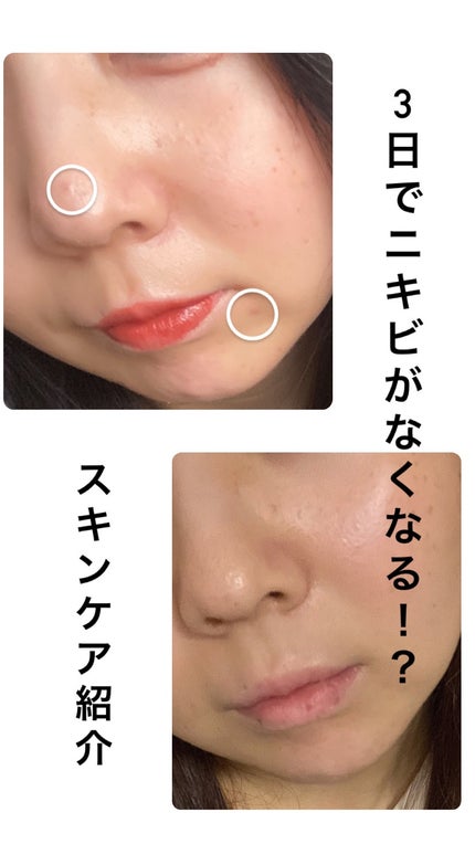 オードムーゲ 薬用ローション(ふきとり化粧水)/オードムーゲ/拭き取り化粧水を使ったクチコミ(1枚目)