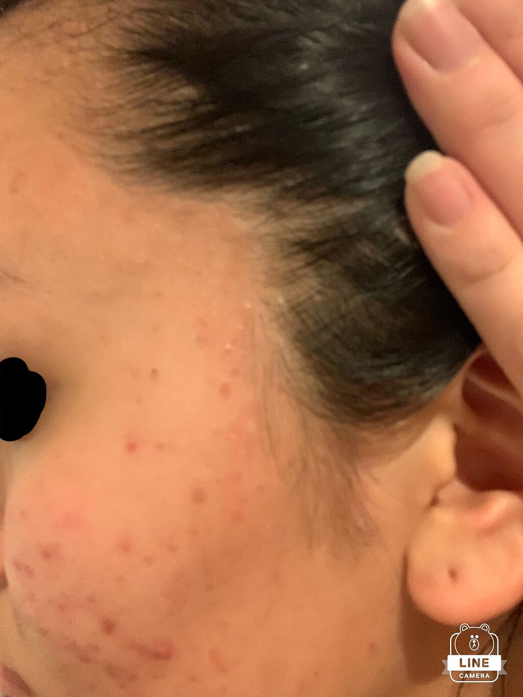 モモ on LIPS 「前の投稿消してしまったので、再度載せ直し🎞肌荒れし放題の肌を治..」(4枚目)