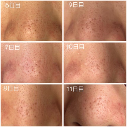 毛穴アンプル/ブラン/美容液を使ったクチコミ(3枚目)