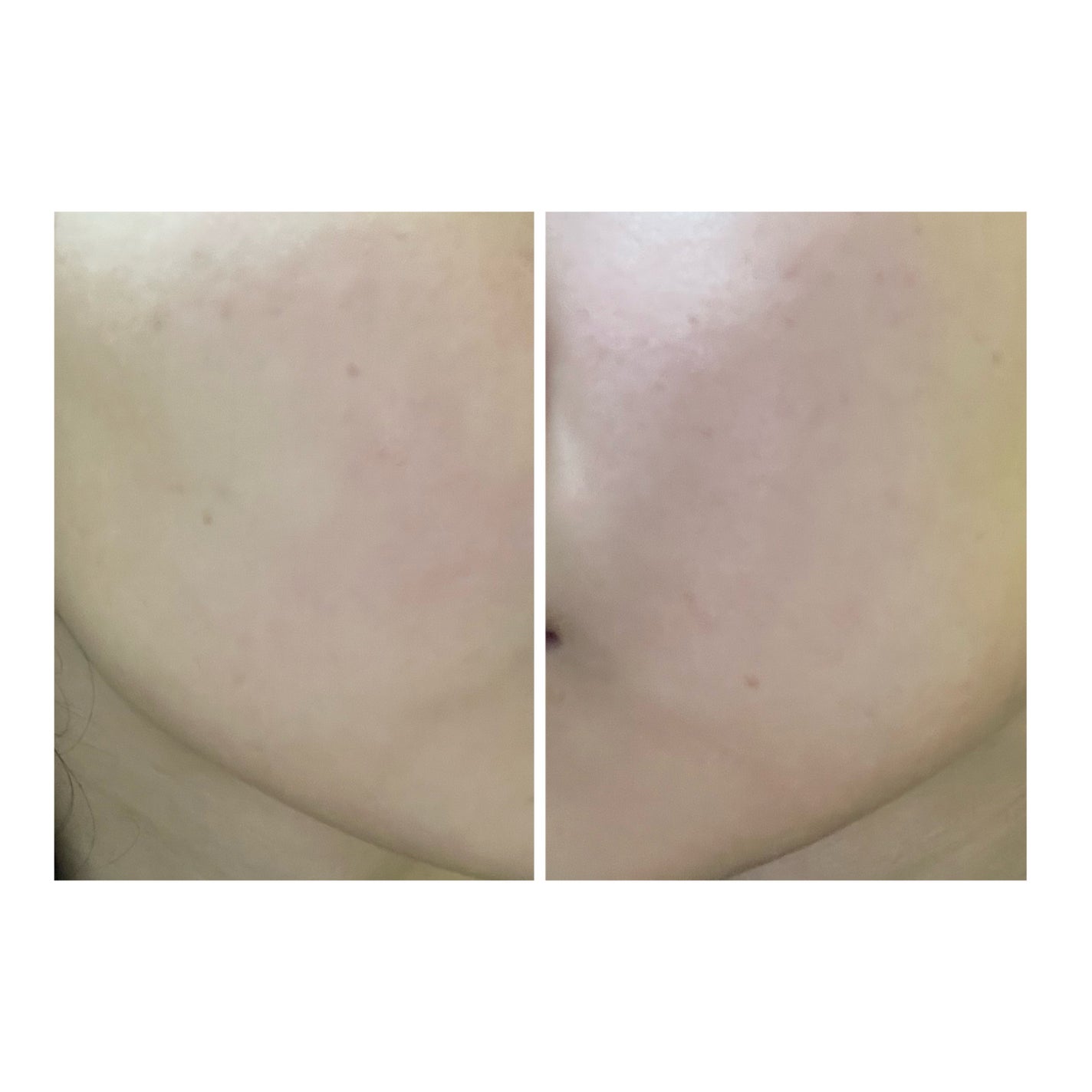 ぽむ on LIPS 「2023.9.13皮膚科に受診 エピデュオとヘパリン処方1枚目..」(2枚目)