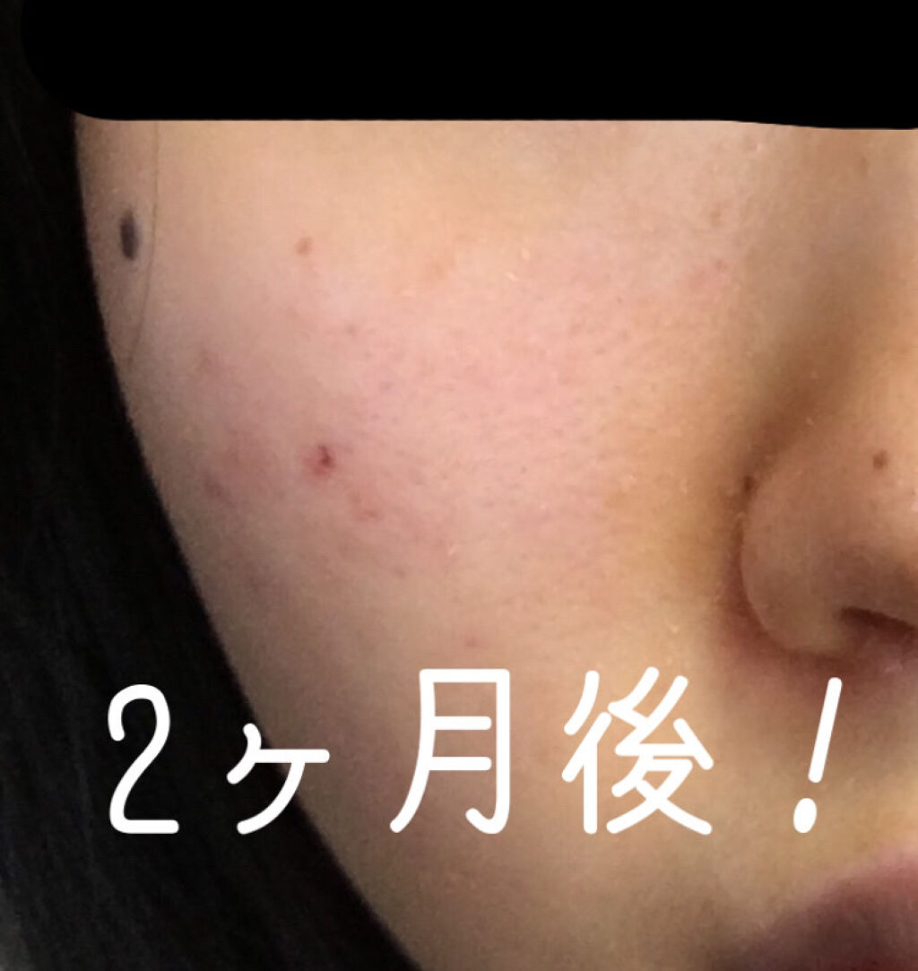 ACアクティブ フェイスローション モイスト/NOV/化粧水を使ったクチコミ（2枚目）