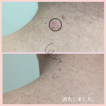 レッドアクネ ボディピーリングショット/MEDICUBE/ピーリングを使ったクチコミ(6枚目)