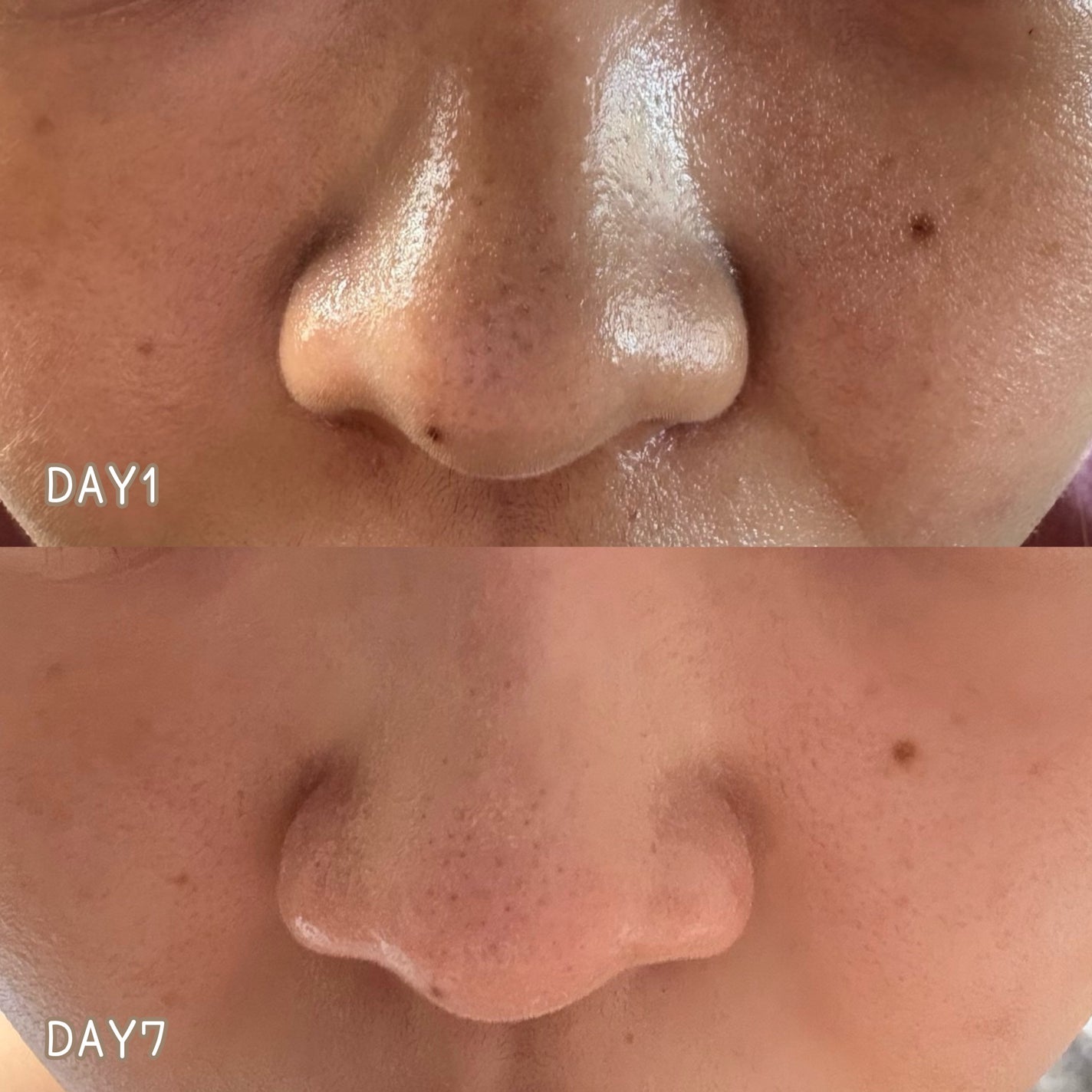 ダーマレーザー スーパーAZ100マスク/クオリティファースト/シートマスク・パックを使ったクチコミ(2枚目)