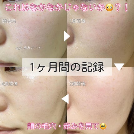 MiRAY/MYTREX/美顔器・マッサージを使ったクチコミ(3枚目)