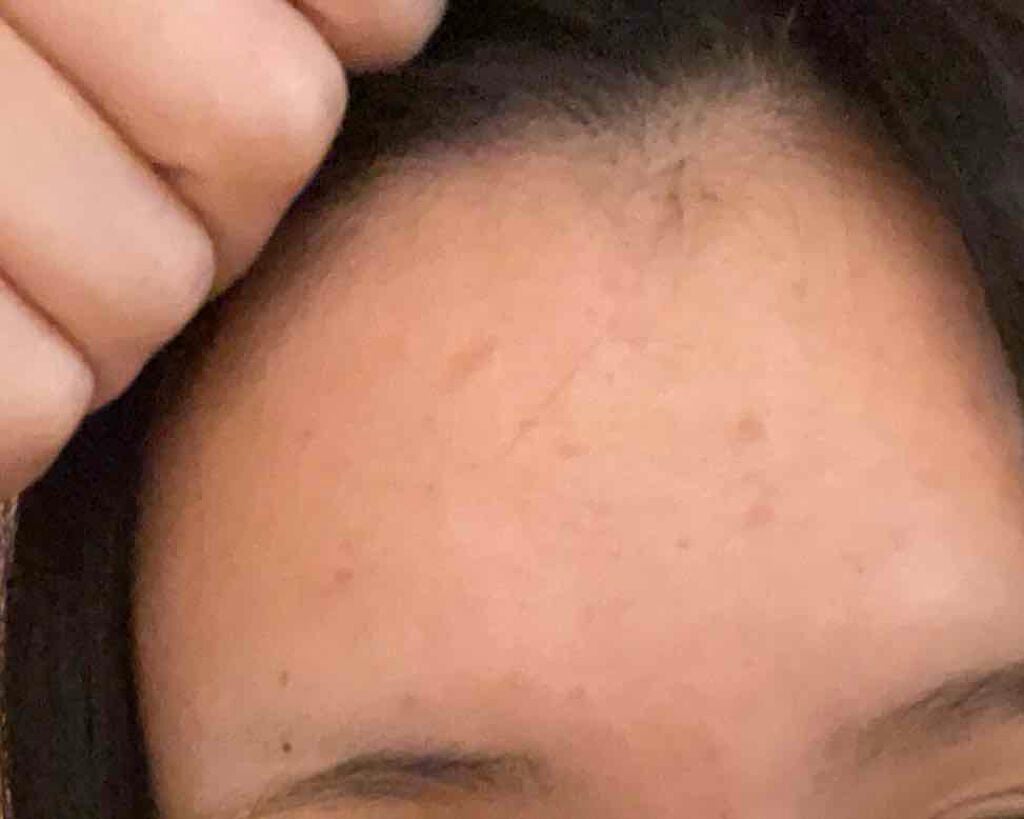 リンカ on LIPS 「《ニキビが酷すぎて悩んでた私がここまで綺麗になれました!》....」(3枚目)