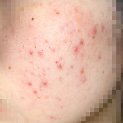 オキシドール(医薬品)/日本薬局方/その他を使ったクチコミ(3枚目)