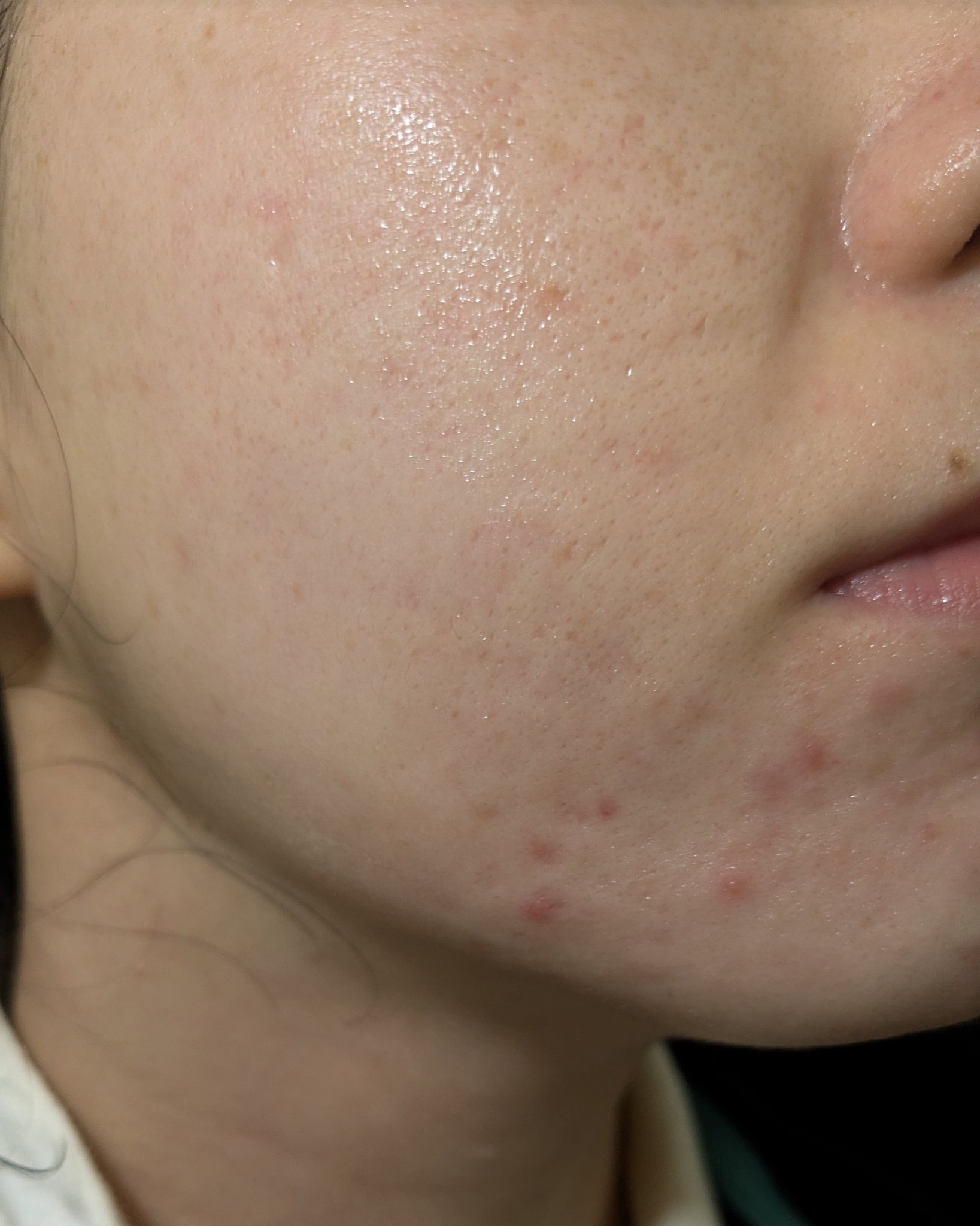 10/30の#汚肌工事録

😂😂
頑張っててもどうもできないと辛いです


💐肌がのためにやっていること

💊乳酸菌やビタミンサプリ:朝昼晩(昼はたまに抜かしちゃう)
💊低量ピルも飲んでます！(酷かった生理ニキビや生理痛・PMSは